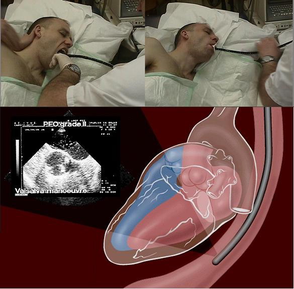 Трансэзофагеальная эхокардиография